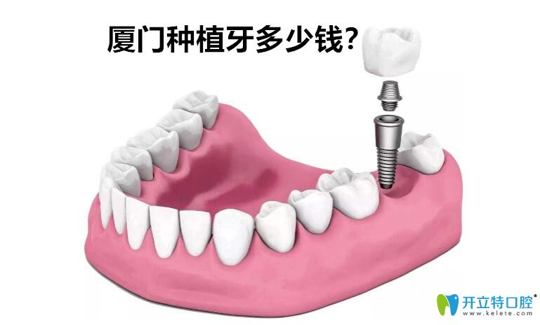廈門種植牙多少錢？剛整理的廈門種植體品牌價格表供參考