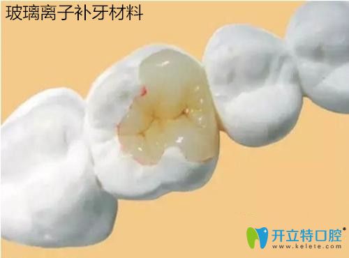 玻璃離子補牙材料