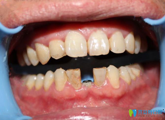 我找寧波恒美口腔徐路路做的即刻種植牙效果好價(jià)格還不貴