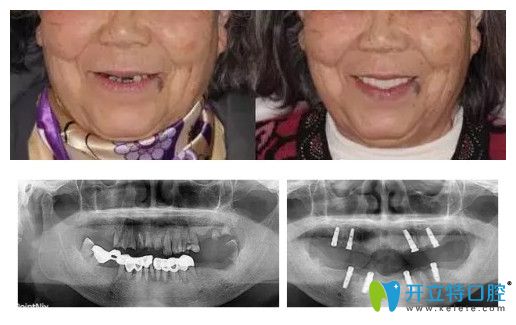 北京中諾全口牙種植<span style=