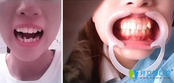 靠譜!在北京中諾口腔做金屬自鎖托槽矯正15個月亂牙變齊啦