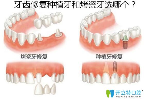 18歲缺失牙齒修復(fù)種植牙和烤瓷牙選哪個(gè)？