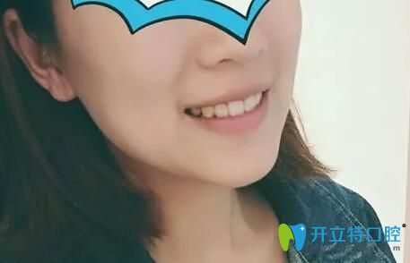 我在北京中諾口腔做牙齒矯正15個月