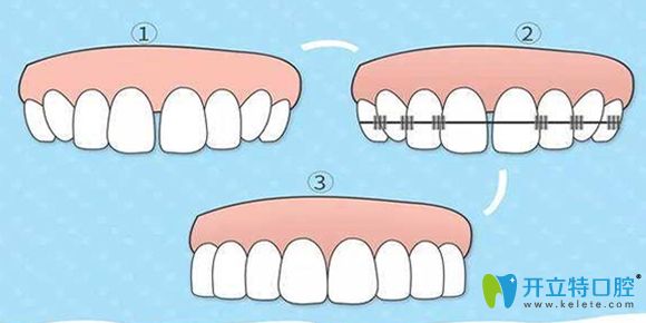 杭州一牙口腔解說杭州牙齒矯正需要多少錢