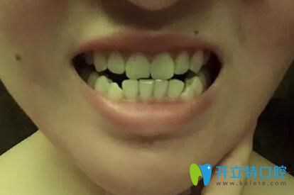 武漢仁愛口腔武漢牙齒矯正哪家醫(yī)院好?仁愛口腔潘少群正畸技術(shù)就很靠譜