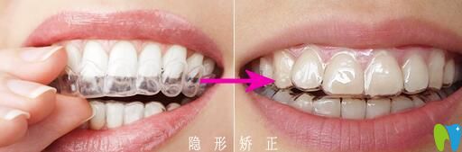 隱適美隱形矯正