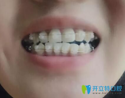 <!--<i data=20240703-sp></i>-->口腔潘少群給我做牙齒矯正第6個(gè)月