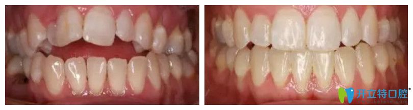 成都圣貝齙牙矯正<span style=