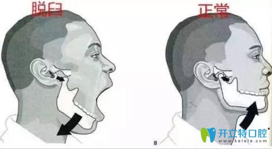 下巴錯位與正常對照圖