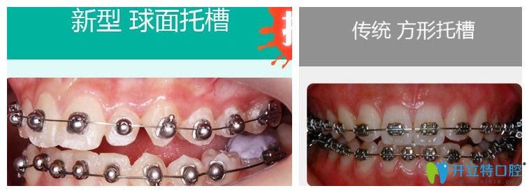 球面托槽矯正和傳統(tǒng)矯正圖示