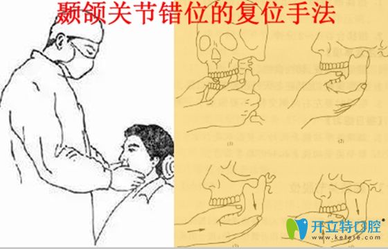 顳頜關(guān)節(jié)錯位的復(fù)位治療手法圖