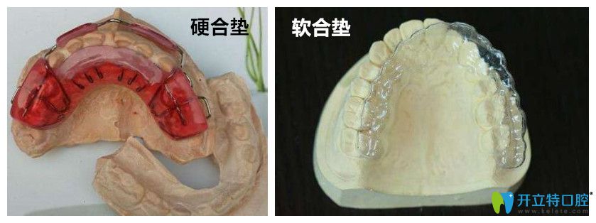 顳下頜關節(jié)紊亂采用頜墊進行治療