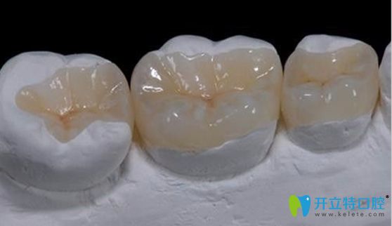 嵌體修復適合活髓牙而高嵌更適合于死髓牙修復