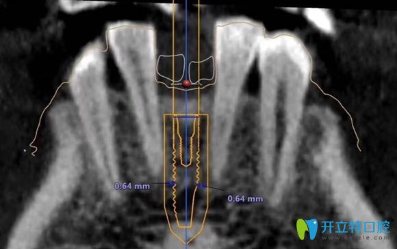 南京博韻口腔的種植可以避開頜骨中的重要血管神經(jīng)