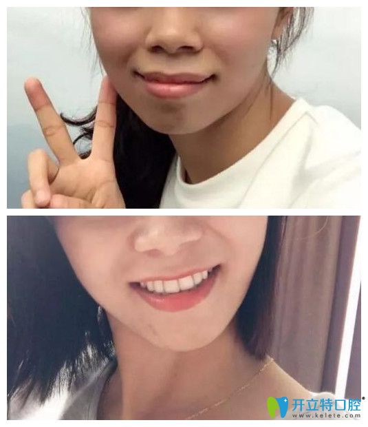 小齙牙矯正前后正面臉型對比圖