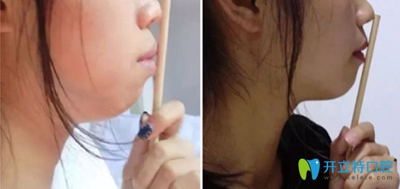 齙牙矯正前和矯正一年后的對(duì)比效果圖