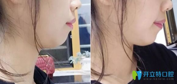 我的牙性加骨性齙牙戴金屬牙套矯正一年半后的效果圖