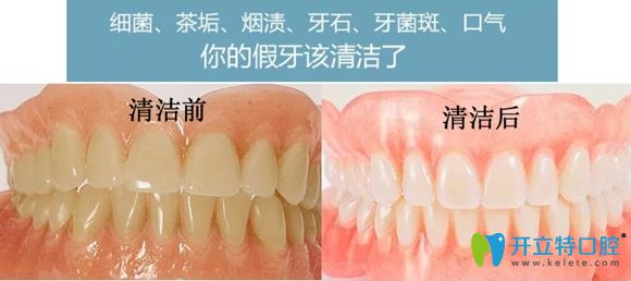 做好假牙清潔可有效避免活動義齒戴久了特別臭的尷尬呦!