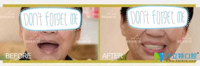 深圳美萊口腔全口種植牙案例