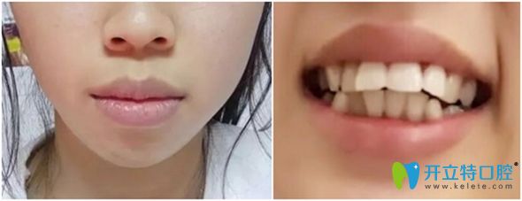 我的嘴凸是齙牙引起的,在威海舒好口腔做牙齒矯正后改善了