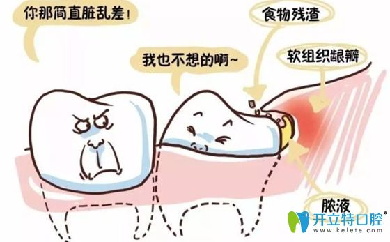 智齒長歪了會容易積聚食物殘渣