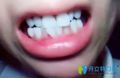 都說深圳諾德齒科種植牙出名,其實(shí)牙齒矯正效果也很贊喲!