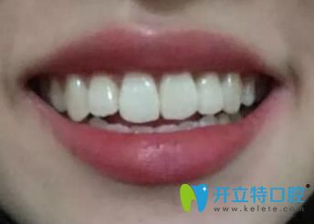 我在煙臺百仕口腔做牙齒矯正1年半