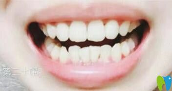 我在煙臺百仕口腔做牙齒矯正10個月