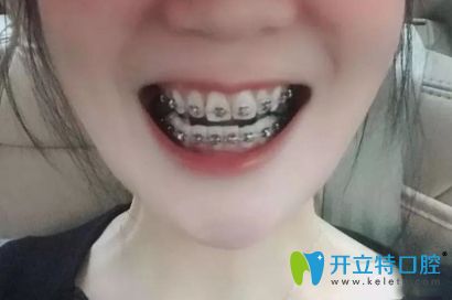 我牙齒矯正一年后的效果圖