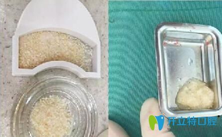 種植牙的人工骨粉