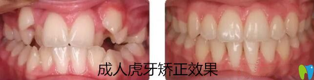 成人虎牙矯正案例效果