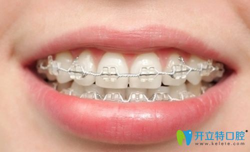 牙齒矯正整齊后的圖