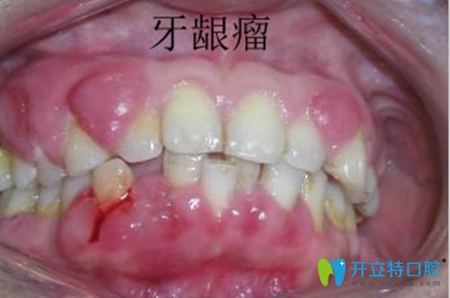 好怕怕!妊娠期牙齦瘤怎么控制?是不是腫瘤？