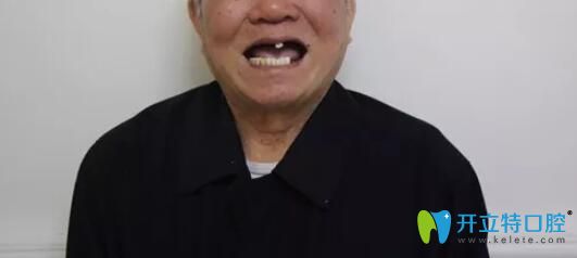 廣州柏德牙科87歲老人讓廣州柏德口腔薛啟明做了半口種植牙后來談感受