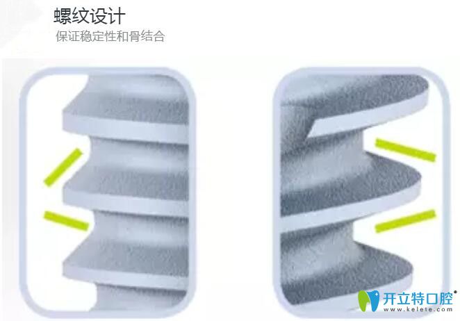 法國安卓健種植體表面螺紋設(shè)計