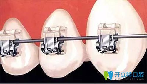 做牙齒矯正時牙套中鋼絲起的作用可千萬別小瞧了!