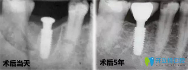 法國安卓健種植牙穩(wěn)定性強