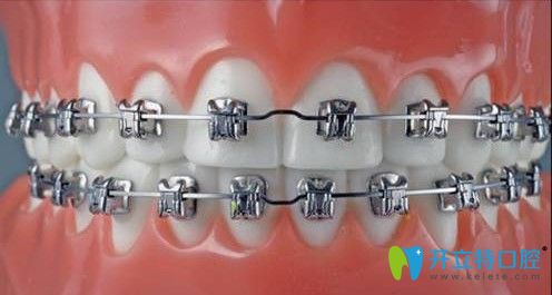 華美口腔中心金屬矯正圖示