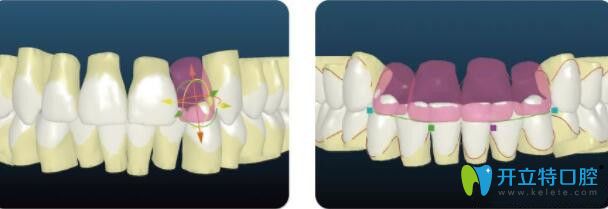 insignia數(shù)字化正畸效果