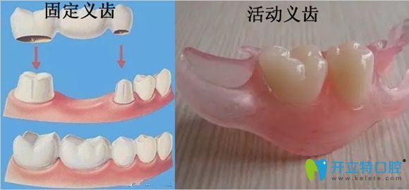 固定義齒和活動(dòng)義齒修復(fù)缺牙示意圖