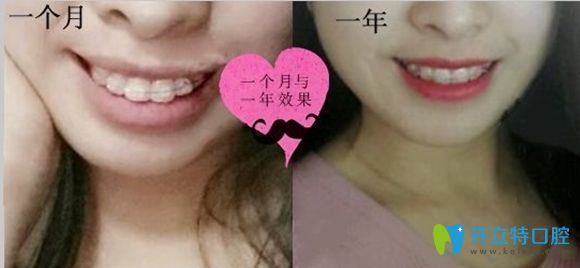 深圳潤(rùn)澤瑞尼絲口腔齙牙矯正前后效果圖 深圳潤(rùn)澤瑞尼絲口腔齙牙矯正前后效果圖