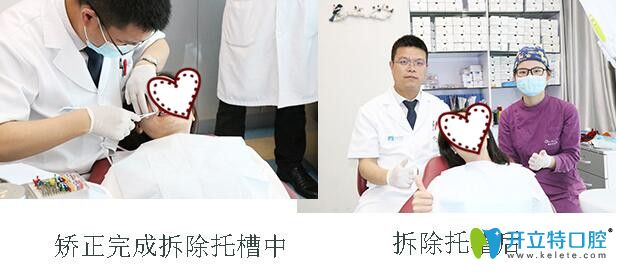 在深圳格倫菲爾口腔做半隱形矯正2年拆牙套