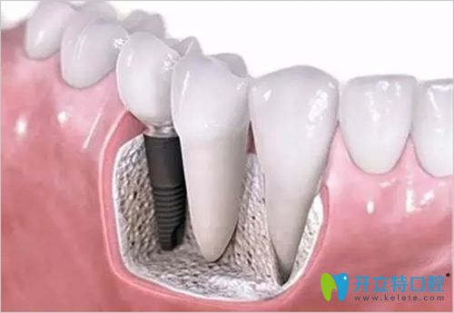 種植牙修復(fù)示意圖