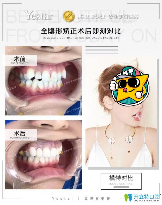 藝星口腔時(shí)代天使隱形矯正不齊牙齒<span style=