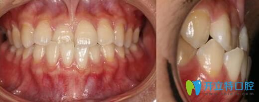 反頜解除!在北京瑞鯊口腔望京店做地包天矯正2年下牙套啦