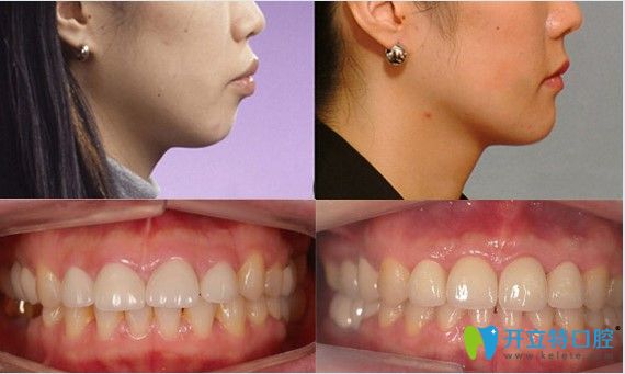 齙牙矯正， 隱形矯正16個月效果圖