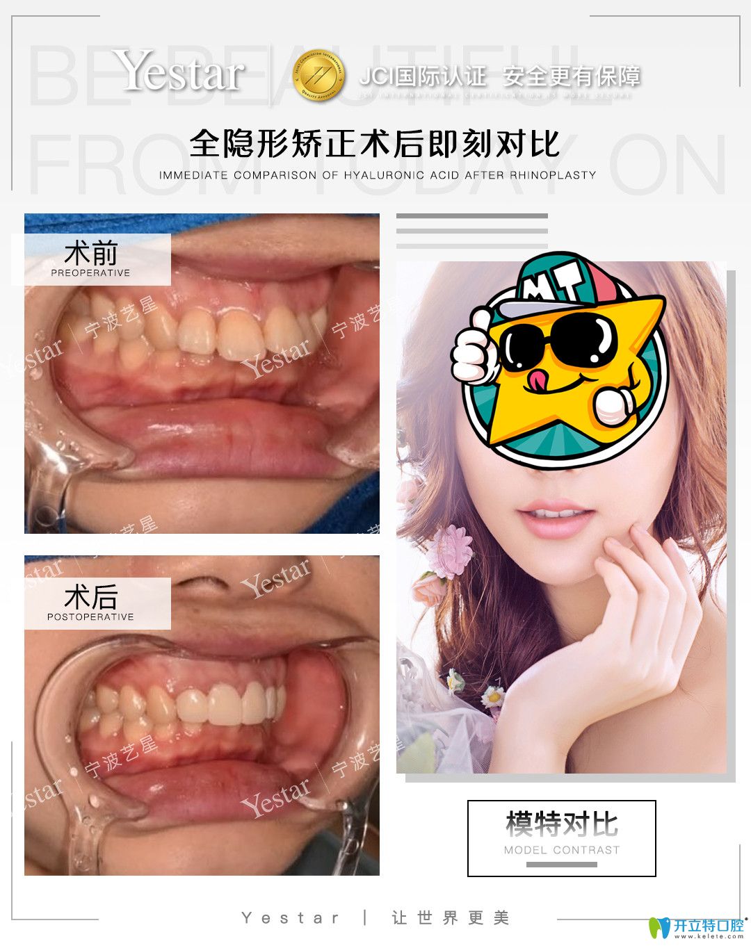 藝星口腔門牙外翻采用隱適美矯正的<span style=