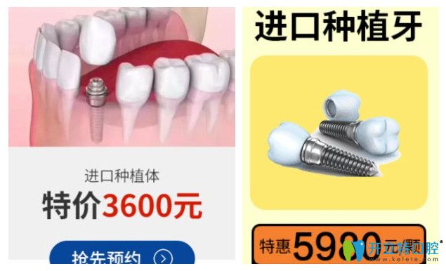 正夫口腔其他種植體價(jià)格圖