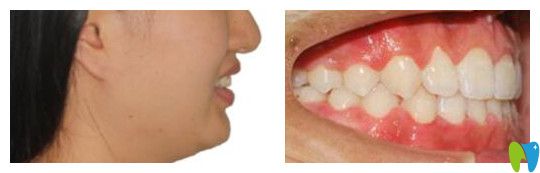 我在北京瑞莎口腔做地包天矯正2年效果