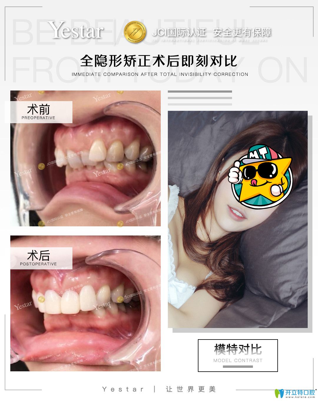 在寧波藝星口腔戴隱形牙套是什么感受，真實(shí)正畸經(jīng)驗(yàn)分享